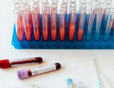 Blood tests for hair loss at Stephen James Trichology in Saffron Walden 