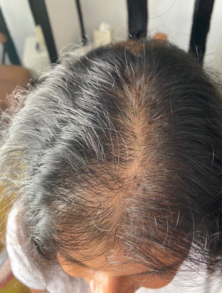 Before hair loss treatment at best trichologists in Chelmsford, Saffron Walden, Essex
