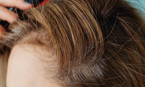 Trichotillomania solutions at Stephen James Trichology Oxford Essex Birmingham