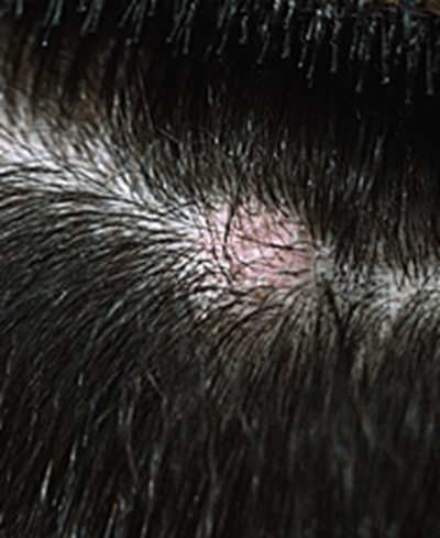 fungal hair infection support at Stephen James Trichology
