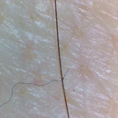 hair loss treatments in Banbury, Saffron Walden, Birmingham