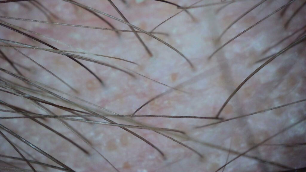 hair shedding solutions at stephen james trichology in oxford, essex, birmingham