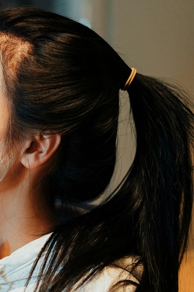 traction alopecia treatments in Oxfordshire, Essex, West Midlands