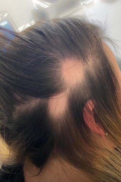 alopecia treatments in West Midlands, Essex, Oxfordshire